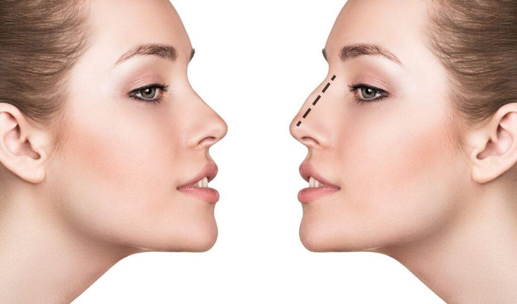 come rimpicciolire naso naturalmente