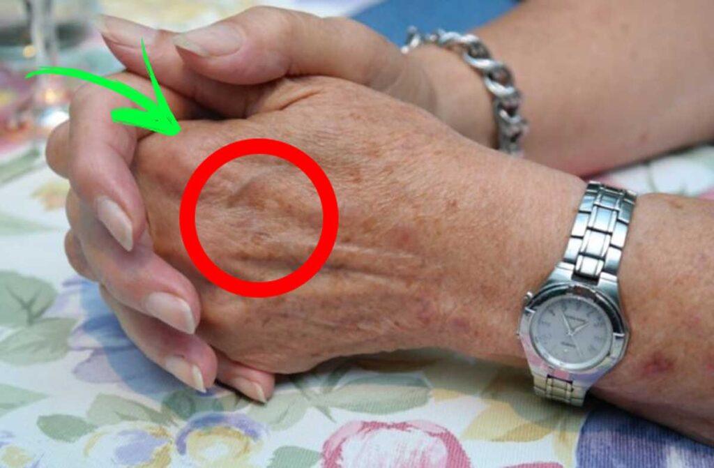 macchie marroni sulle mani