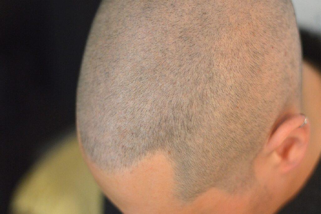 Quanto costa la tricopigmentazione